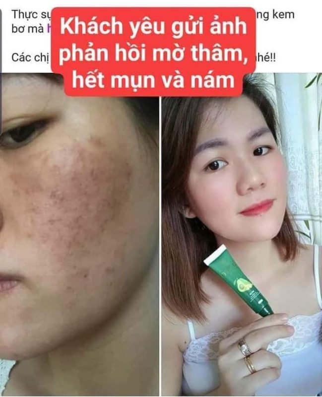 kem bơ cấy trắng nano olic- phản hồi của khách hàng sau khi sử dụng kem bơ olic