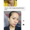 serum peel da tái tạo da cổ mộc lan