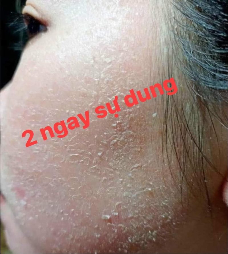 serum peel da tái tạo da cổ mộc lan